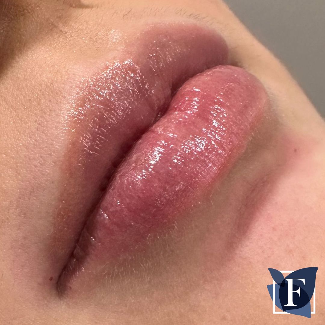 Dermal Fillers at Frontalis Clinic